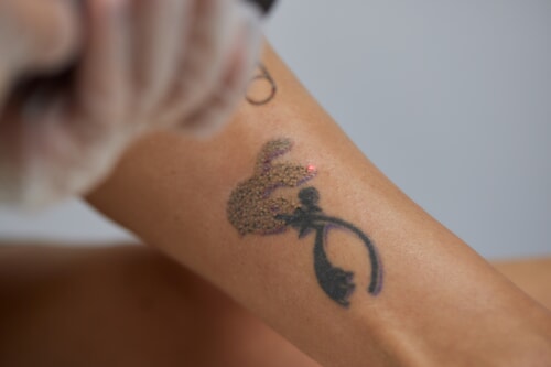 tattoo removal